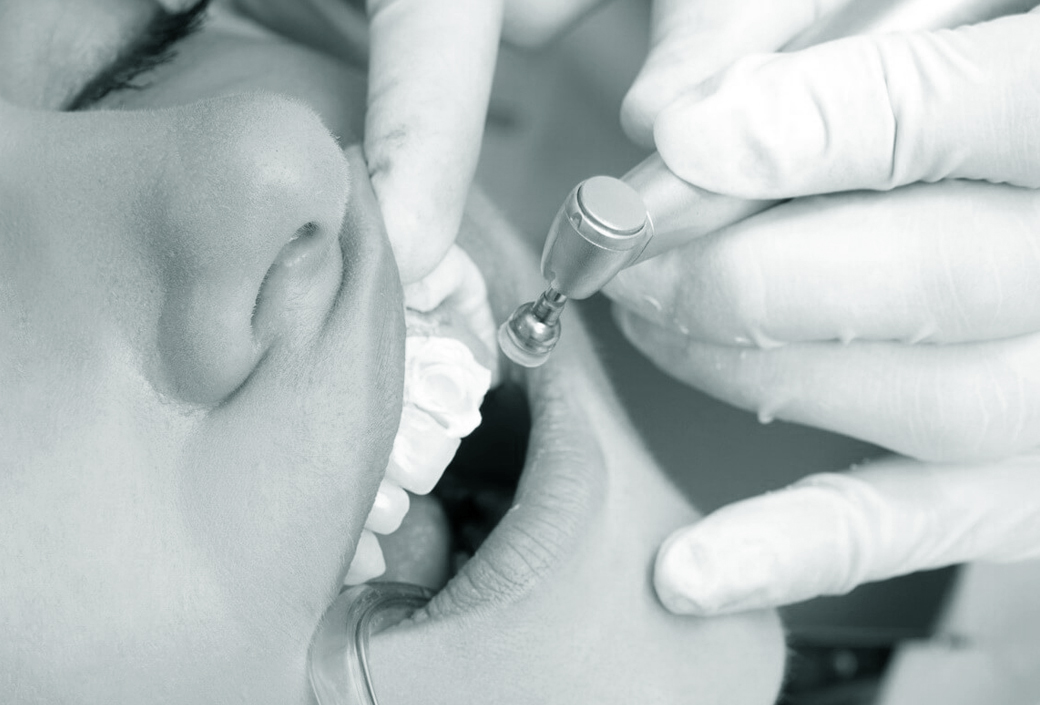 Dişlərin ultrasəs təmizlənməsi